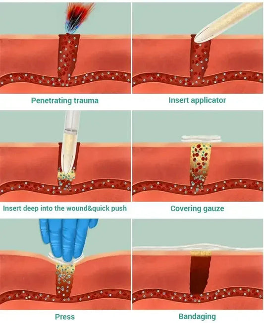 Chitosan Powder Applicator with Hemostatic Granule Bandage for Emergency Use image 1